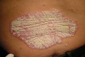 Glofac y la Psoriasis